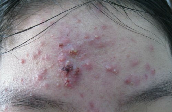 Phương pháp điều trị mụn theo phác đồ của ngành da liễu hiện nay