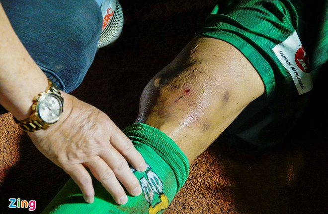 Đầu gối cầu thủ đội Sài Gòn biến dạng sau cú đạp từ đối thủ