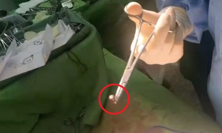 Đi trộm chó bị người dân dùng súng hơi bắn thủng bụng