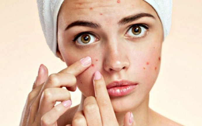 7 cách đơn giản giúp bạn ngăn ngừa mụn trên mặt