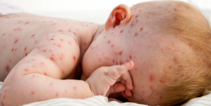 5 bệnh nguy hiểm mà trẻ thường mắc vào mùa hè