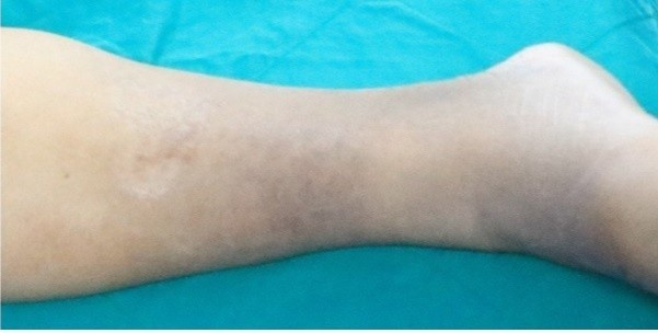 Căn bệnh lạ ở người béo phì