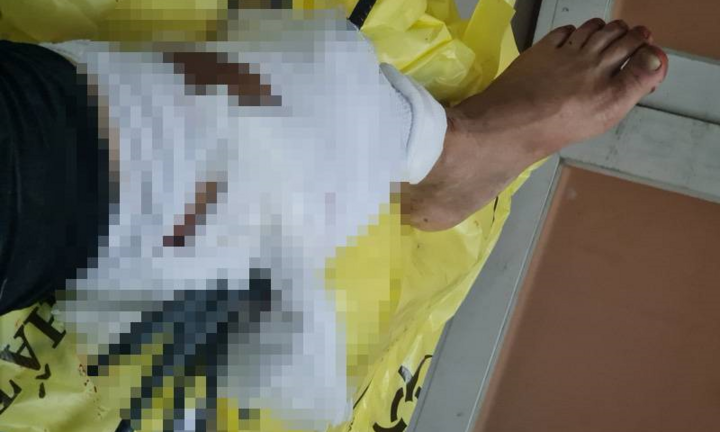 Va chạm với xe ba gác, nam thanh niên bị 11 thanh sắt đâm xuyên chân