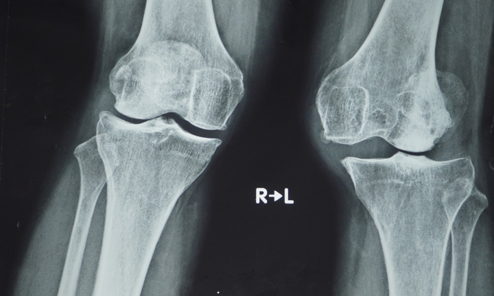 Lần đầu tại Việt Nam phẫu thuật thay khớp gối dạng bản lề bằng titanium