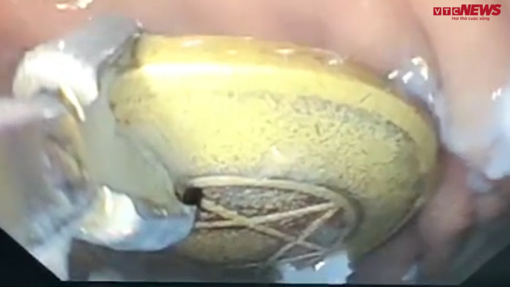 Video: Nội soi gắp đồng xu trong đường tiêu hóa bé gái 8 tuổi ở An Giang