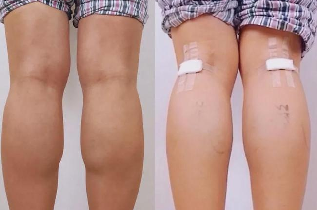 Kiểu làm đẹp rùng rợn của gái trẻ Trung Quốc: Cắt dây thần kinh để bắp chân thon