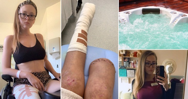 Tiệc tùng say sưa, cô gái tỉnh dậy thấy đã mất một chân 