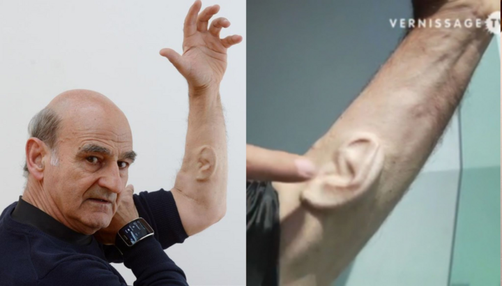 Kỳ lạ người đàn ông ‘mọc’ thêm tai ở cánh tay, nguyên do còn gây kinh ngạc hơn