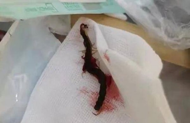 Cô gái và bác sĩ đều rụng rời khi phát hiện con rết dài 5cm làm tổ trong tai 