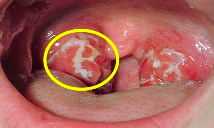 Ung thư vòm họng: Triệu chứng sớm nhất là gì, cách điều trị ra sao?