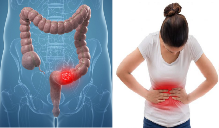 5 triệu chứng sớm của ung thư ruột: Cần khám và điều trị ngay khi thấy nghi ngờ