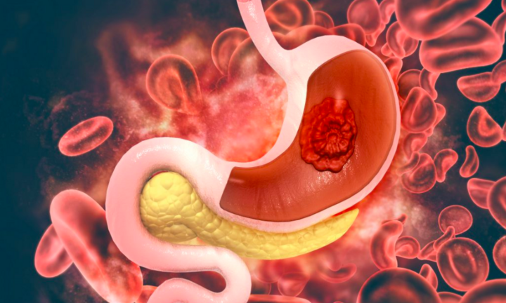 Ung thư dạ dày: 4 dấu hiệu sau khi ăn cảnh báo bệnh đã âm thầm tấn công cơ thể