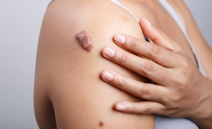 Ung thư da: Cách tự phát hiện triệu chứng sớm nhờ quan sát nốt ruồi bất thường