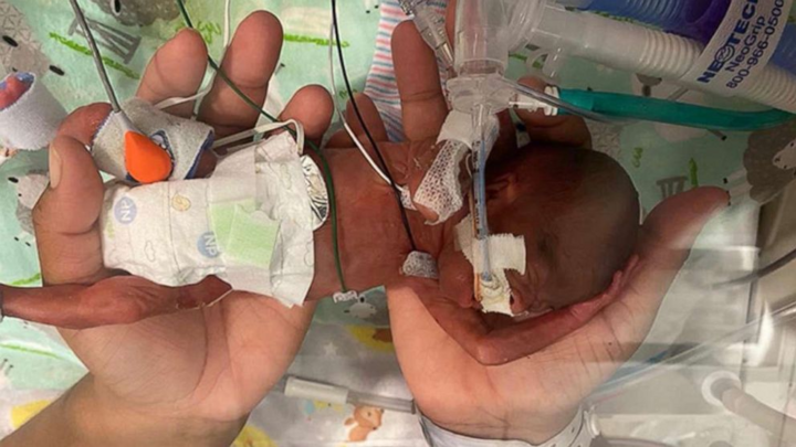 Em bé sinh non nhất thế giới sống sót diệu kỳ dù chỉ có 1% cơ hội