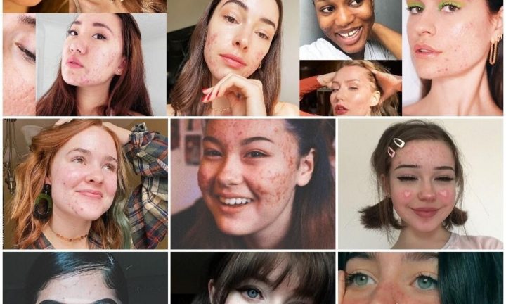 Suy nghĩ tích cực về mụn, vượt qua sự tự ti để yêu thương chính mình