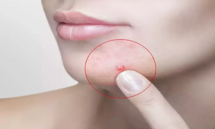 5 dấu hiệu thiếu hụt vitamin biểu hiện trên khuôn mặt