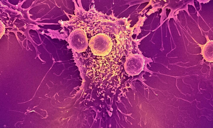 Cảnh báo bệnh ung thư nguy hiểm: Một triệu chứng sẽ xuất hiện khi uống rượu