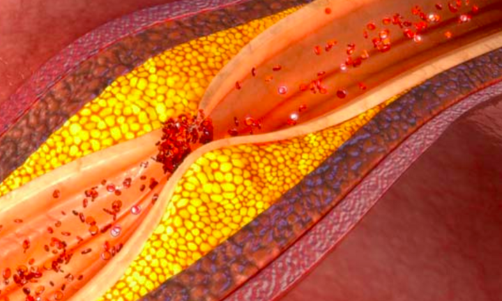 5 dấu hiệu cảnh báo mạch máu bị tắc nghẽn: Nên đi khám ngay khi vừa phát hiện