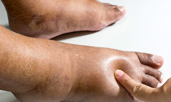 5 tín hiệu cảnh báo bệnh tiểu đường giai đoạn muộn: Cẩn thận với biến chứng nặng