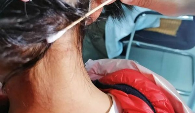 Tưởng nốt ruồi sau gáy, hóa ra bị bọ hút máu ký sinh