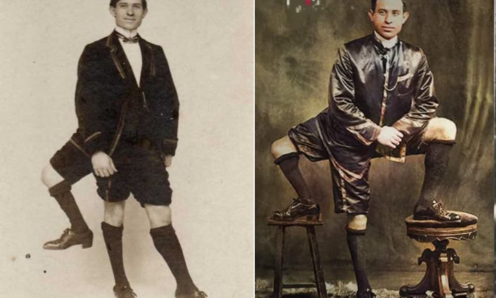 Người đàn ông ‘mọc thừa’ chân thứ 3, tưởng bất hạnh mà lại kiếm được bộn tiền