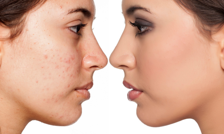 Điều trị mụn trứng cá hiệu quả, cách nào?