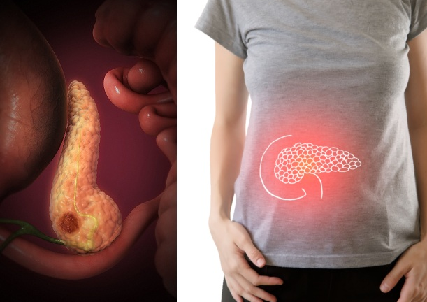 Những dấu hiệu cảnh báo ung thư tuyến tụy: Có cảm giác khác lạ ở dưới xương sườn