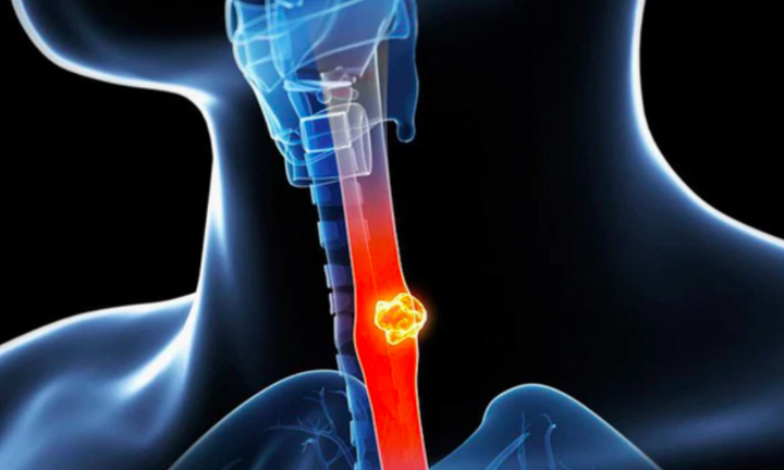 8 dấu hiệu cảnh báo ung thư thực quản: Phát hiện sớm tỷ lệ chữa khỏi sẽ cao hơn