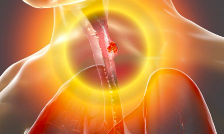 4 thói quen ‘nuôi lớn’ ung thư thực quản: Cách ăn uống sai gây hậu quả lớn nhất