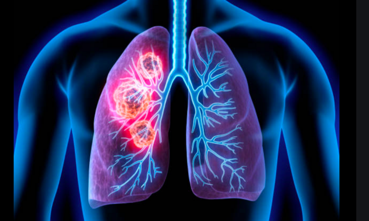 5 loại 'khí' làm tăng nguy cơ ung thư phổi: Muốn ngăn ngừa bệnh thì nên tránh xa