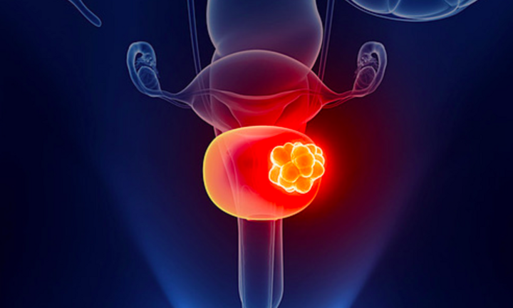 4 dấu hiệu cảnh báo ung thư bàng quang: Phát hiện sớm có thể kéo dài sự sống