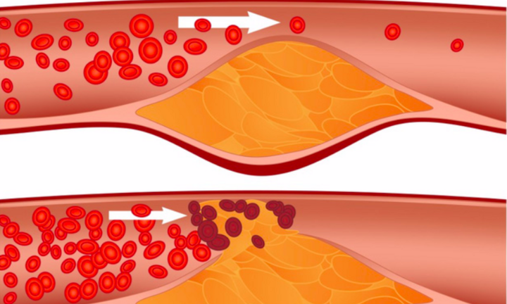 5 thực phẩm 'quét rác' mạch máu tốt nhất: Mạch thông tuổi thọ cao, ngừa đột quỵ