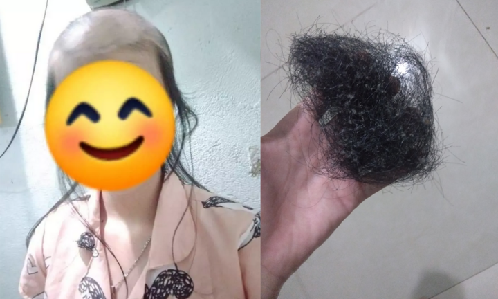 Sốc với mái đầu gần trụi nhẵn tóc của cô gái, xót xa khi biết là bởi 1 thói quen