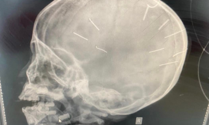 Tình trạng bé gái 3 tuổi có đinh trong sọ vẫn rất nặng