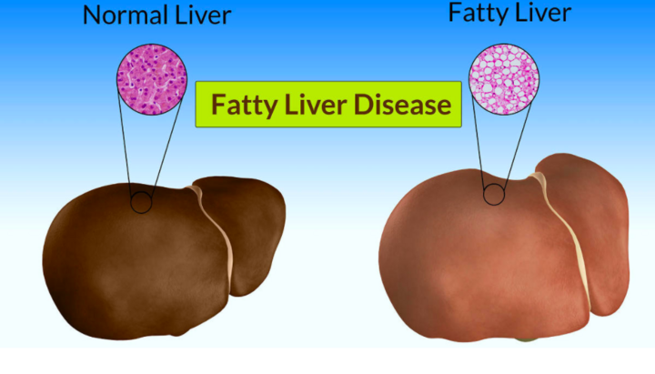 Bị gan nhiễm mỡ: Gợi ý 4 phương pháp Đông y không dùng thuốc để xử lý hiệu quả