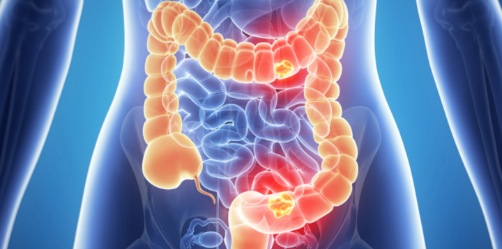 5 dấu hiệu sớm của bệnh ung thư ruột: Cảnh báo ca bệnh tăng gấp đôi ở người trẻ