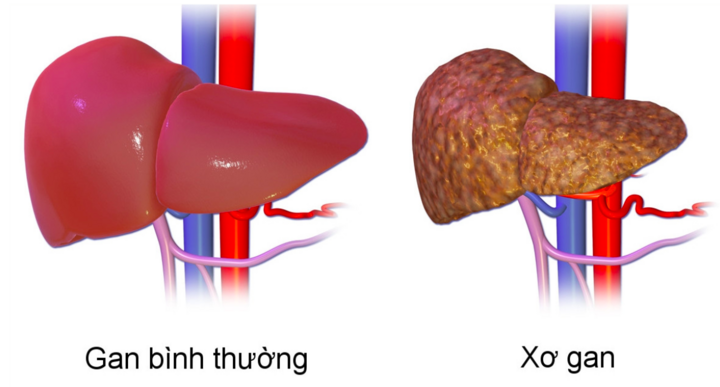 4 dấu hiệu bệnh xơ gan giai đoạn đầu: Phát hiện sớm có thể cứu sống người bệnh