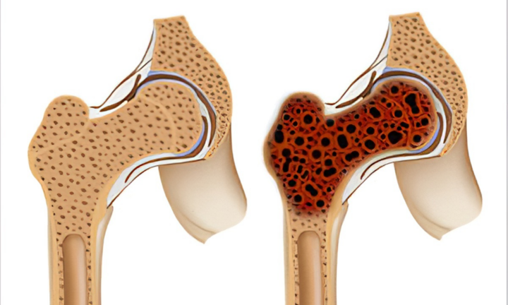 Dấu hiệu ung thư xương: Lời khuyên từ chuyên gia giúp bạn phòng ngừa hiệu quả