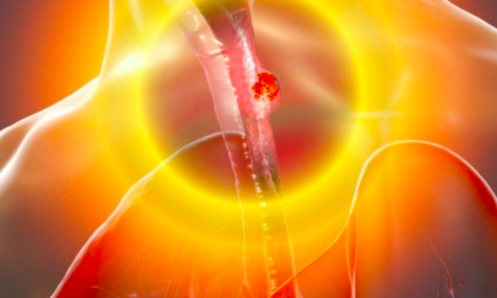 4 nhóm người có nguy cơ mắc ung thư thực quản: Nên biết sớm để ngừa rủi ro