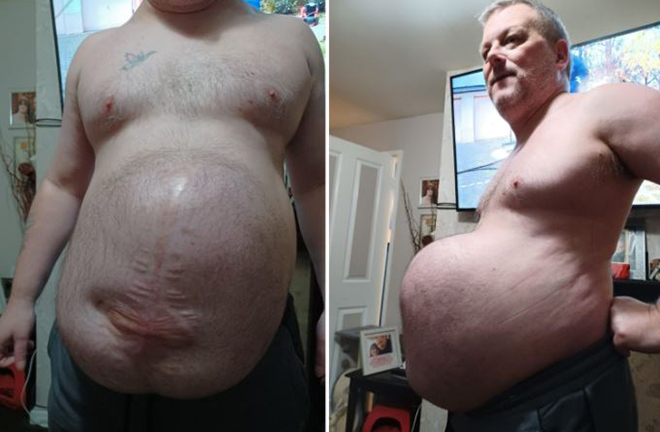 Người đàn ông 'mang bụng bầu 9 tháng' chỉ vì dịch COVID-19