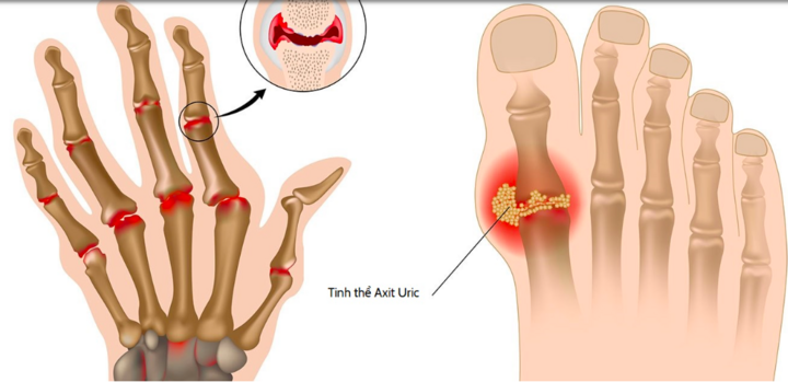 Bệnh gút gây đau đớn khiến bạn bị ám ảnh: Gợi ý cách đẩy lùi bệnh tật hiệu quả