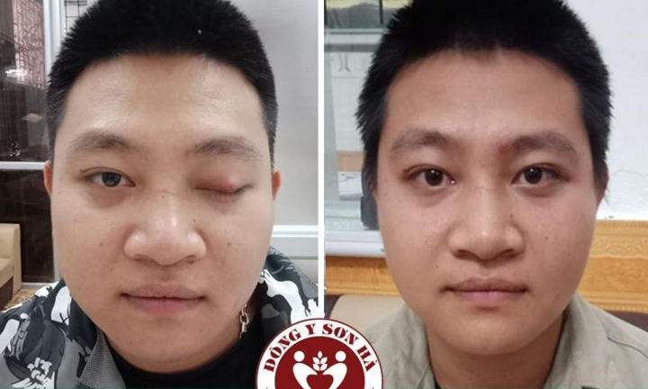 Địa chỉ chữa sụp mí mắt bằng Đông y hiệu quả