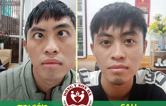 Phương pháp chữa lác mắt hiệu quả bằng Đông y