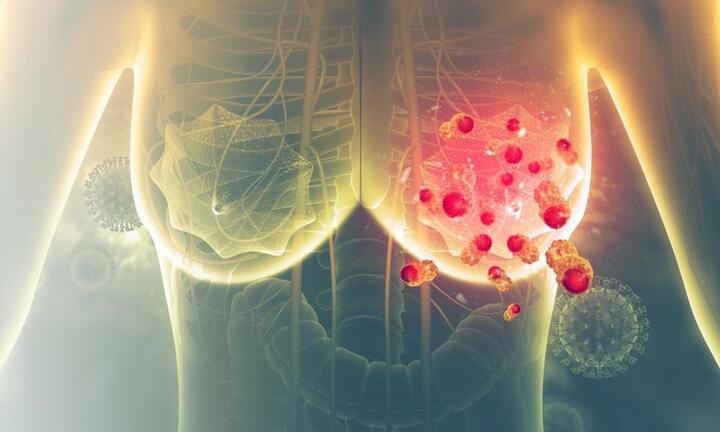 7 thói quen tai hại tăng nguy cơ ung thư vú: Thay đổi càng sớm càng tốt