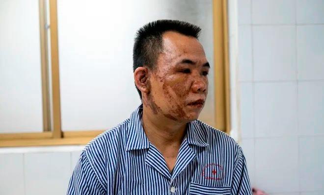 Tạt axit sau cãi vã ở Quảng Ninh: 3 nạn nhân là người đi đường, có bé 3 tuổi