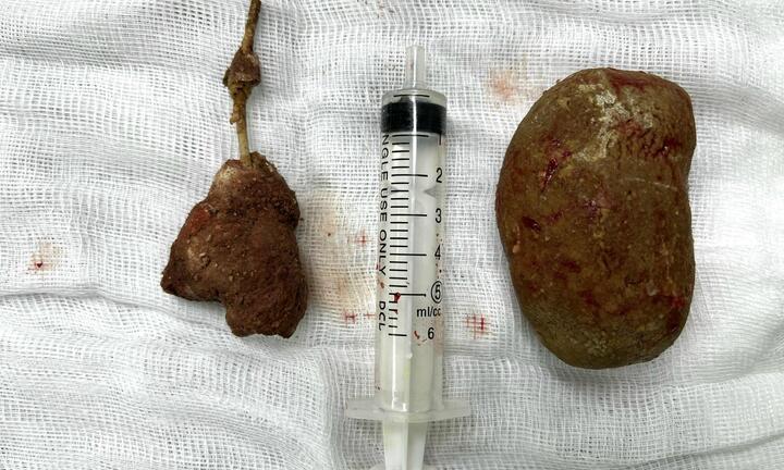 Viên sỏi to hơn quả trứng gà trong bàng quang của nam thanh niên 27 tuổi