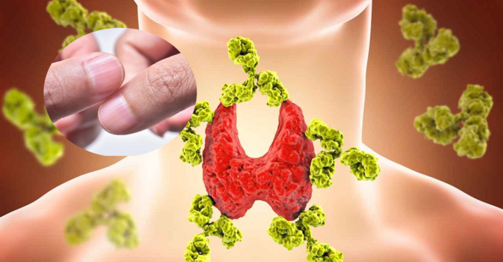 Các dấu hiệu sớm cảnh báo bệnh suy giáp, bắt đầu từ sự thay đổi lạ trên móng tay