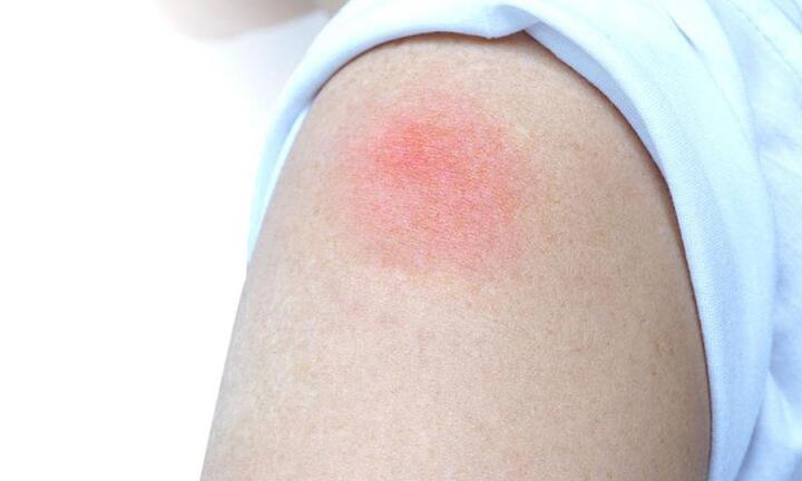 Hiện tượng 'cánh tay COVID' sau tiêm vaccine ở trẻ: Cha mẹ cần nhớ điều này