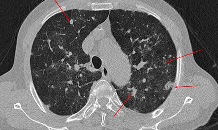 Phổi đông đặc sau 20 ngày khỏi COVID-19