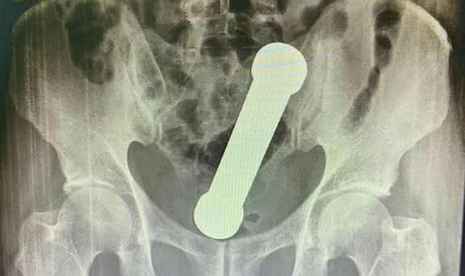 Quả tạ 2 kg mắc kẹt trong trực tràng người đàn ông khiến bác sĩ choáng váng